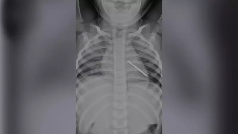 5-cm hairpin removed from 3-year-old's lung after 2 weeks of coughing