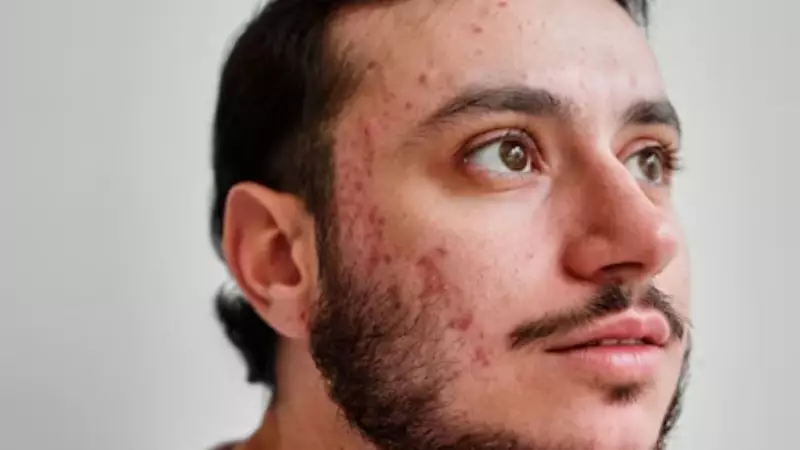 6 Proven Ways to Prevent Frequent Hormonal Acne Breakouts