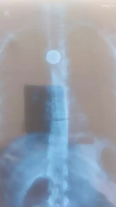 Medical Marvel in Himachal: Doctors Remove Coin Stuck in Girl's Throat for 15 Years