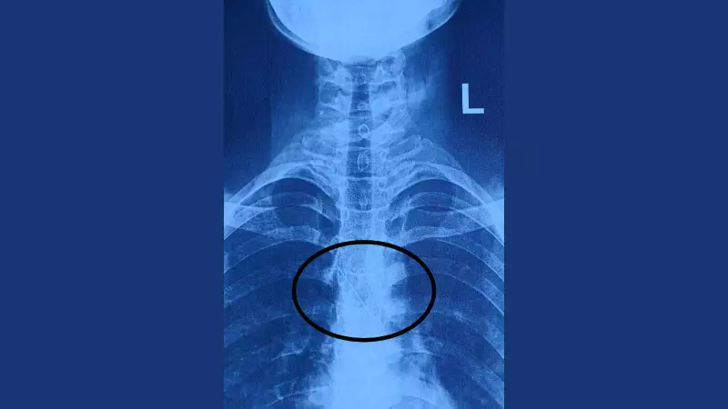 Vadodara Teen's Close Call: Hijab Pin Swallowed, Lodges Near Heart