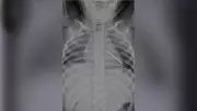 5-cm hairpin removed from 3-year-old's lung after 2 weeks of coughing