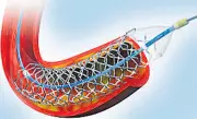 Indian-Made Heart Stent Gets Global Recognition: A Medical Breakthrough
