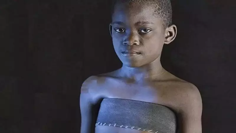 Breast Ironing: The Silent Scars - Devastating Physical & Psychological Trauma on Young Girls