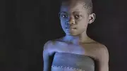 Breast Ironing: The Silent Scars - Devastating Physical & Psychological Trauma on Young Girls