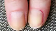 Peeling Nails? Your Body Might Be Sending You a Warning Signal!