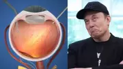 Prima Retinal Implant Breakthrough: Blind Patients Read and See Again, Challenging Elon Musk's Neuralink