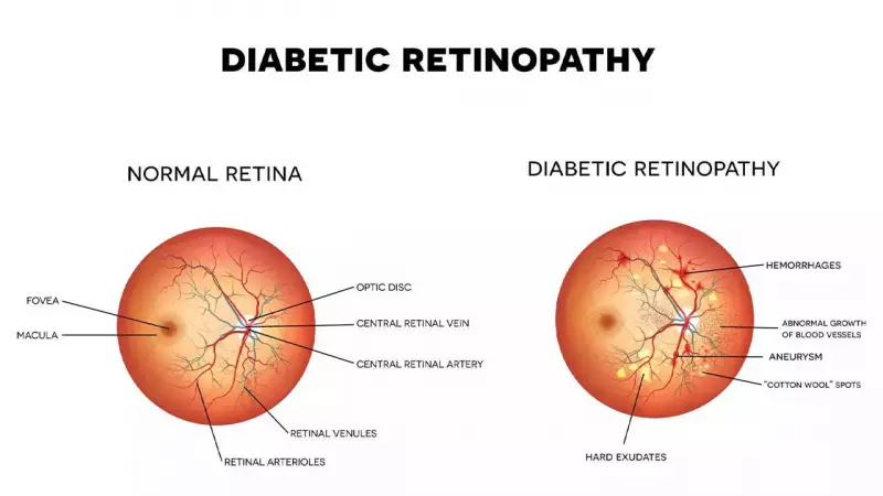 India's Silent Diabetes Crisis: 40 Lakh Face Vision Loss Threat