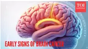 5 Early Brain Cancer Signs Beyond Headaches You Shouldn't Ignore