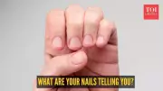 5 Nail Signs That Reveal Serious Health Issues