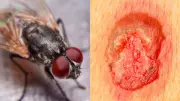 Fly Eggs in Wounds: 7 Critical Signs and Prevention Tips