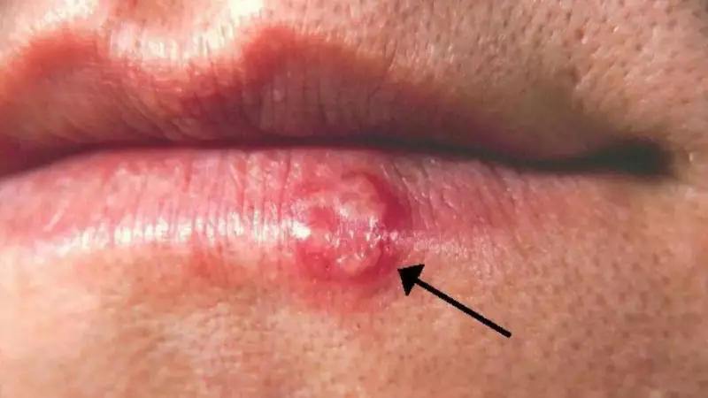 Herpes Simplex Virus: Lifelong Infection, Symptoms, and How to Manage It