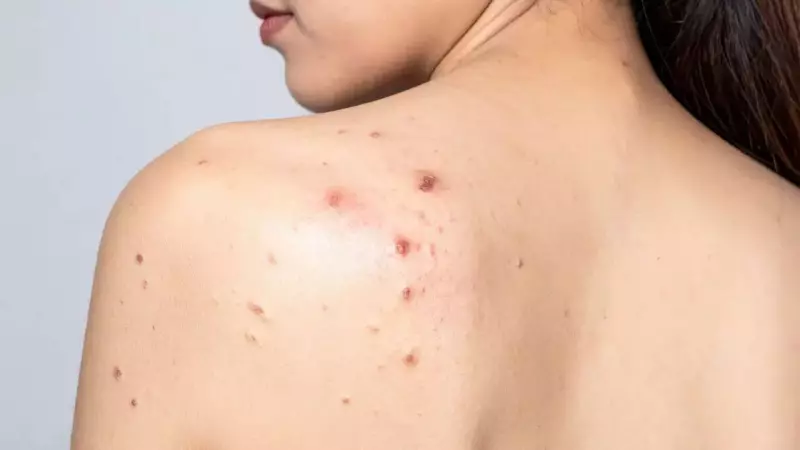 Hot Showers & Back Acne: The Surprising Link & 7 Fixes