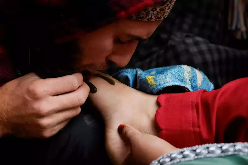 Leech Therapy Revival in Bihar: Ancient Healing Gains Modern Followers