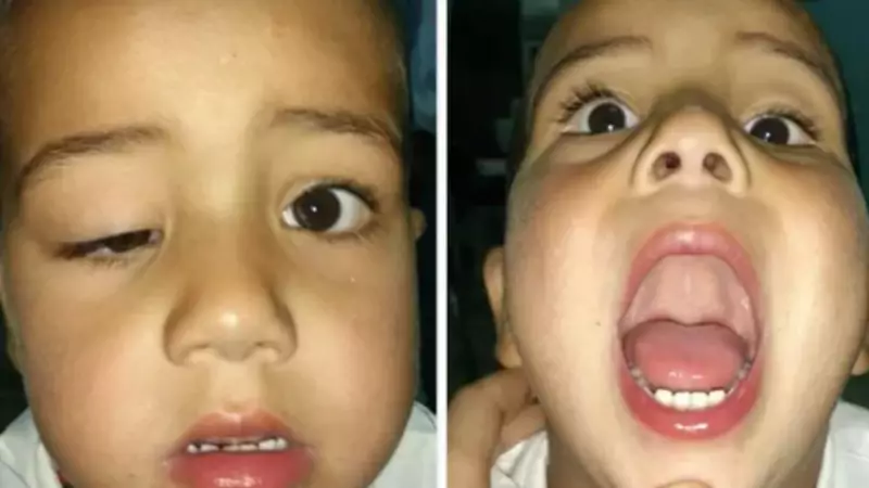Marcus Gunn Syndrome: The Rare Jaw-Winking Condition Affecting 5% of Congenital Ptosis Cases