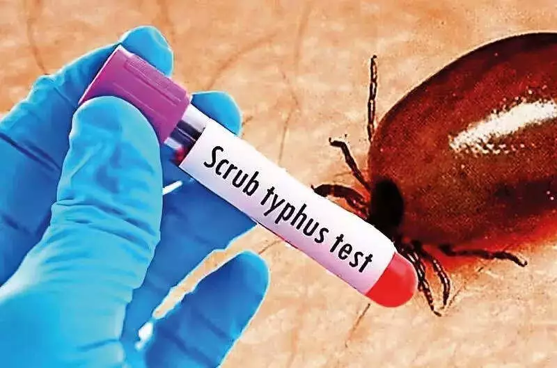 Scrub Typhus Alert: 11 Deaths in Andhra, Telangana Says No Alarm
