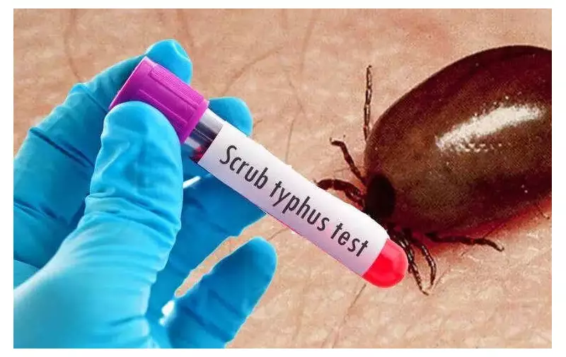 Scrub Typhus Cases Surge Past 130 in Visakhapatnam, Spread to Neighboring Districts