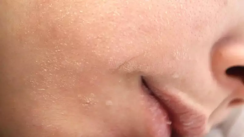 Thyroid Imbalance: How Hypothyroidism & Hyperthyroidism Damage Skin, Hair, Nails