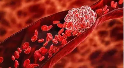 20 Cases of Sickle Cell & Thalassemia Found in A Konduru, NTR District