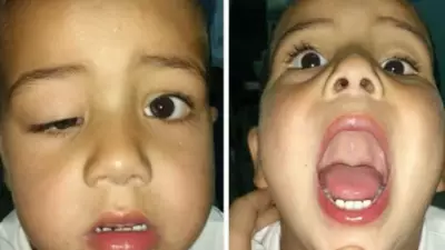 Marcus Gunn Syndrome: The Rare Jaw-Winking Condition Affecting 5% of Congenital Ptosis Cases