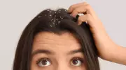 Dandruff Debunked: It's Not Poor Hygiene, It's Scalp Biology