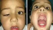 Marcus Gunn Syndrome: The Rare Jaw-Winking Condition Affecting 5% of Congenital Ptosis Cases