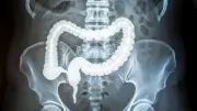Stiff Colon Tissue: A New Early Warning Sign for Rising Colorectal Cancer in Young Adults