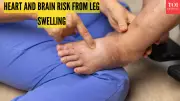 Swollen Legs: A Warning Sign for Heart and Brain Health?