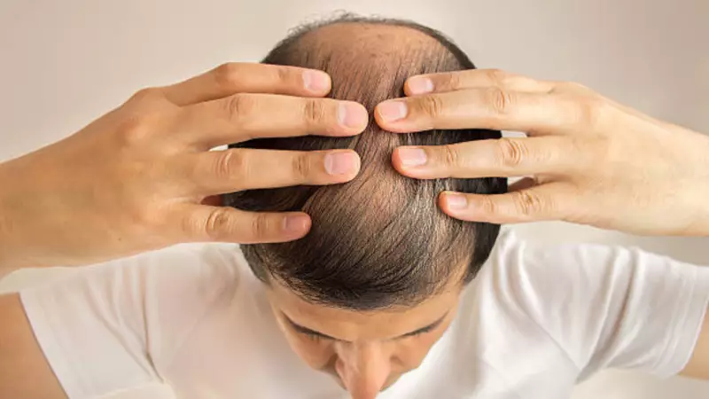 5 Hair Transplant Side Effects: Swelling, Shock Loss & More to Consider