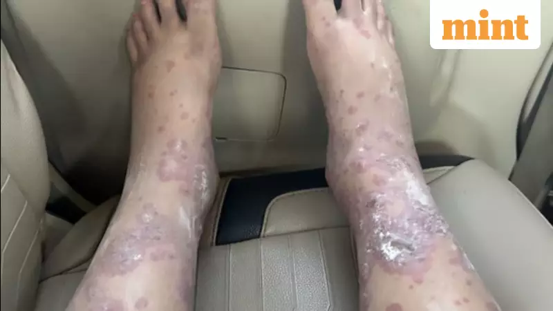 Akasa Air Passenger Alleges Severe Fungal Infection from Unhygienic Flight Seats