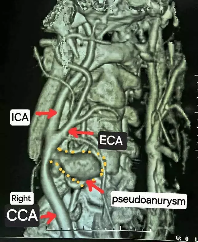 Chhattisgarh Doctors Achieve Rare Feat, Save Man from Spontaneous Neck Artery Rupture
