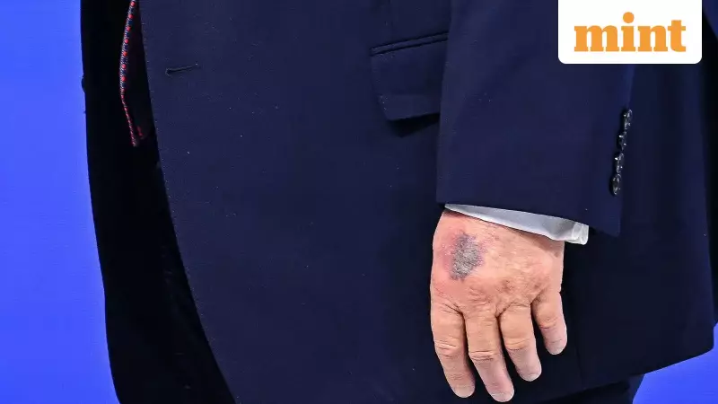 Donald Trump's Hand Bruise Sparks Internet Frenzy; President Blames High Aspirin Dosage