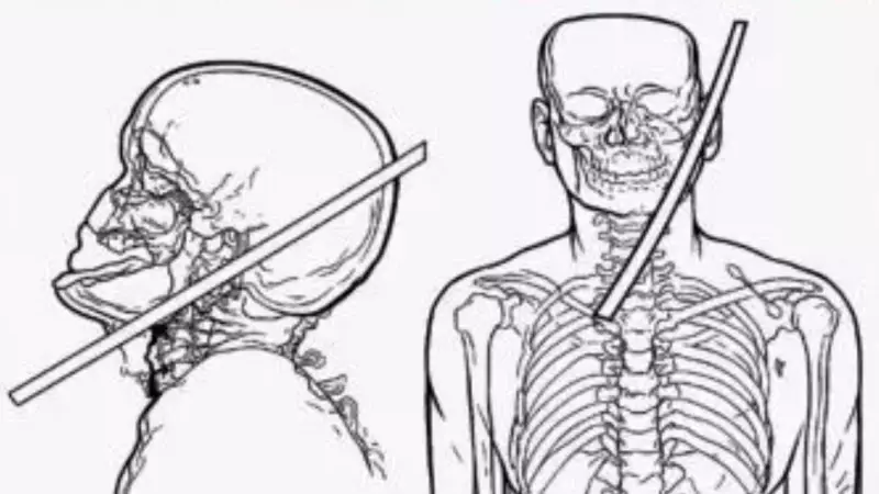 Gurgaon Doctors Perform Miraculous Surgery: Remove 2.5-Foot Steel Rod From Worker's Head