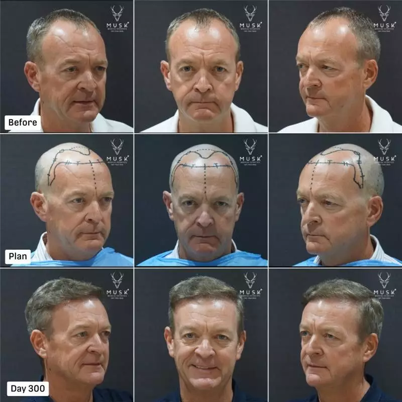 India's Medical Tourism Boom: Global Surge for Aesthetic & Hair Restoration at Clinics Like Musk