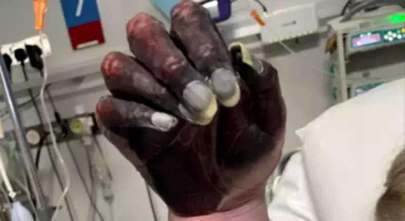 Mother's Arm Amputated After Doctors Dismissed Necrosis as Newspaper Ink