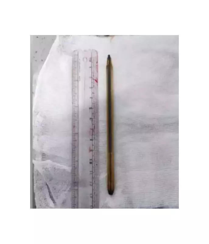 Pen Swallowed in Bet Remains in Teen's Abdomen for 3 Years, Removed in Guntur