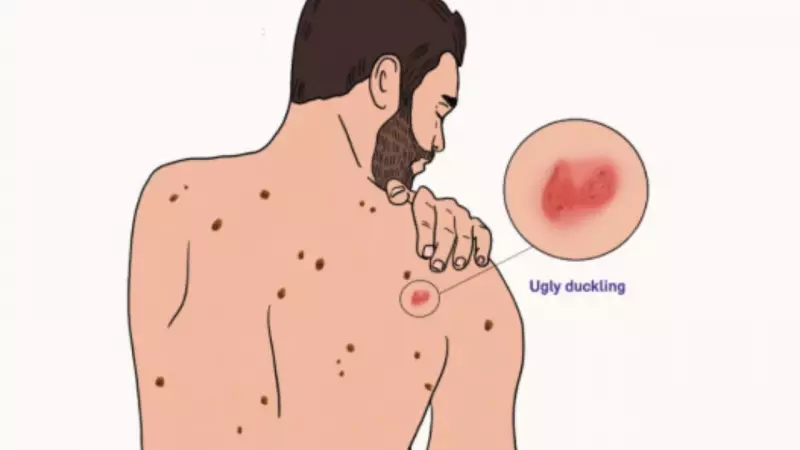 Ugly Duckling Sign: How Spotting Odd Moles Can Save You from Melanoma