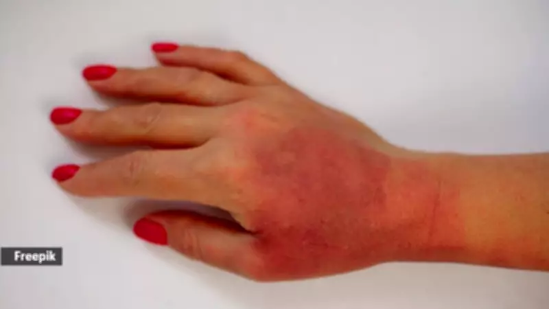 Why Applying Ice to Burns Can Worsen Injuries: Expert Warning
