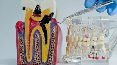 Diabetic Woman Loses Vision After Tooth Extraction: A Rare Case of Metastatic Endophthalmitis