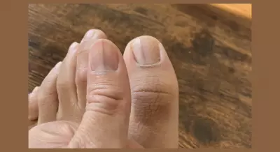 Reddit Users Spot Potential Skin Cancer Signs in Woman's Nail Photo