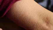 Goosebumps: More Than Just Chills - The Hidden Science of Skin Bumps