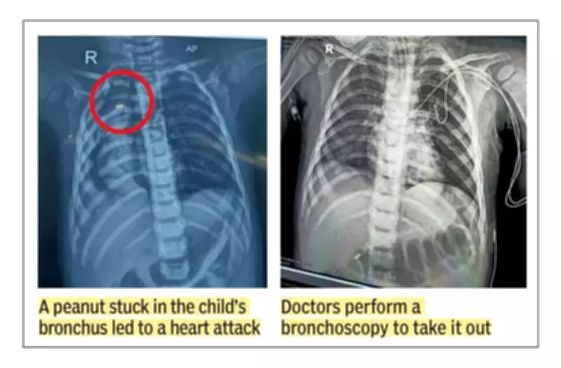 18-Month-Old's Life Saved After Peanut Causes Cardiac Arrest in Noida
