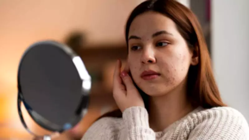 Adult Acne in India: Causes, Treatment, and Rising Cases Over Age 25