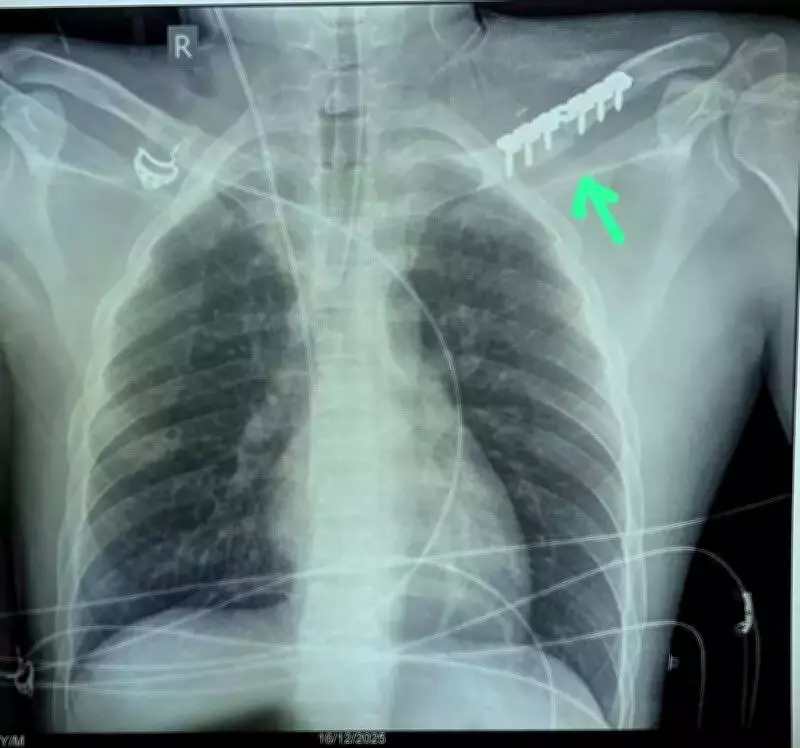 Doctors in Raipur Save Man's Arm with Complex Surgery After Knife Attack