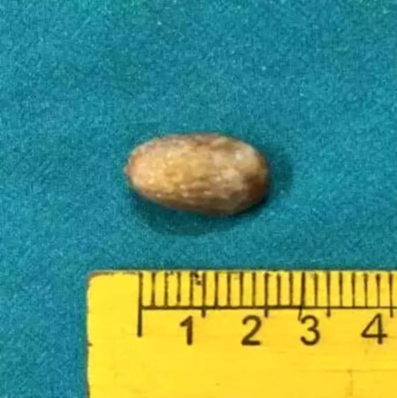 Kolkata Doctors Save Teen by Removing Large Seed from Lung in Critical Surgery