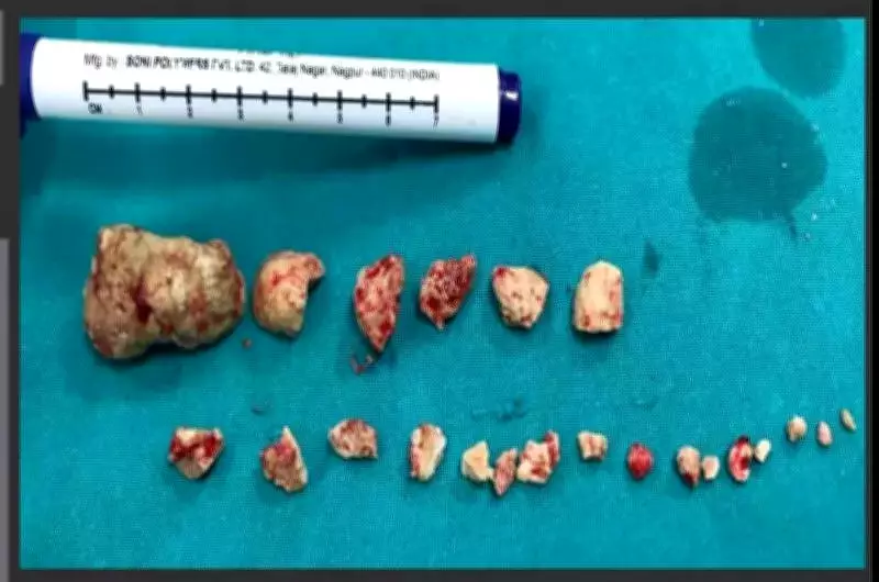 NRI's Fear of Eating Cured by Vadodara Hospital's Pioneering Salivary Stone Procedure