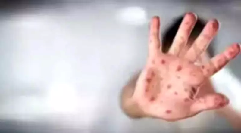 Pune Pediatricians Report Alarming Rise in Chickenpox Cases, Highlight Adult Risks