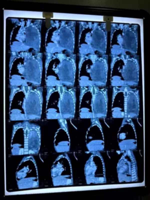 Rare Lung Tumor Overcome: Nadiad Girl's Journey to Health After Aggressive Cancer Battle