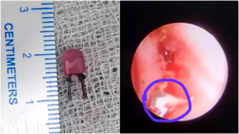 Vadodara Doctors Save Toddler After LED Bulb Found Lodged in Lung