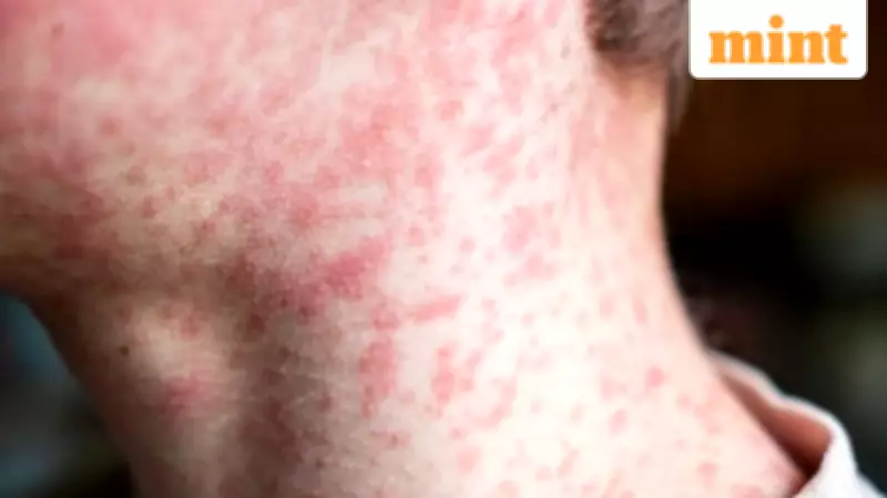 Wake County Measles Outbreak: 18 Cases Reported, Exposure at 5 Raleigh Locations