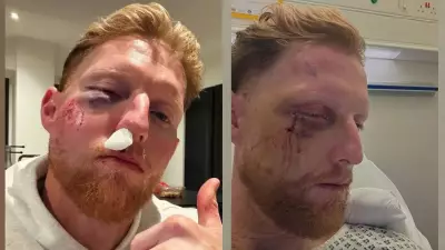 Ben Stokes Undergoes Surgery After Cricket Ball Facial Injury in Nets